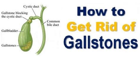 Cause of gall bladder stone. Natural Home Remedies for Gallstones Treatment at Home ...