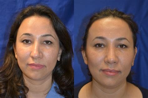 Nose Surgery Before And After Photos Patient 248 San Francisco Ca