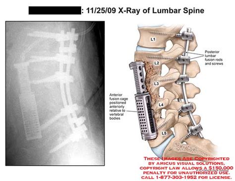 Amicus Illustration Of Amicus X Ray Spine Lumbar Fusion Cage Vertebral Bodies Rod Screw L1 L2 L3