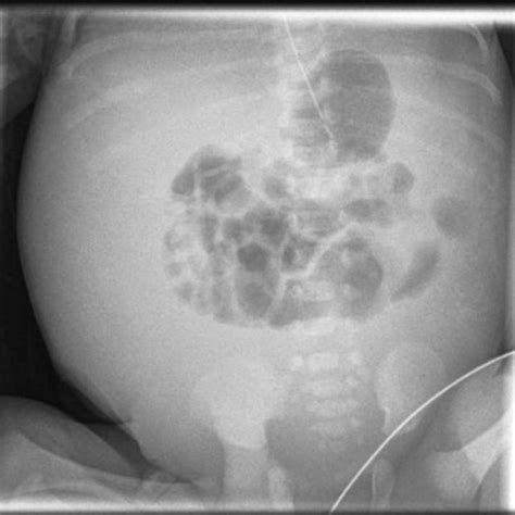 Nfant Showing Massive Ascites And Intense Anterior Abdominal Wall