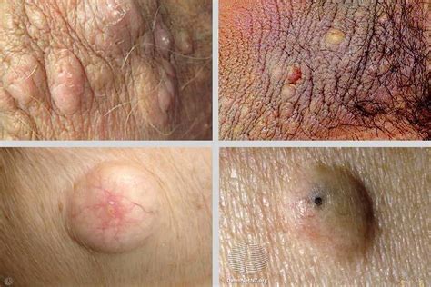 Types Of Sebaceous Cysts Hot Sex Picture