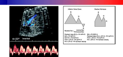 11 The Triphasic Forward Doppler Flow Waveform Of Dv It Is Directed