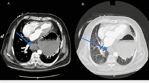 Transverse Section Of Ct Chest Demonstrating A Large Hiatal Hernia And