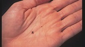 What Are Seed Ticks? Parents Should Be On The Lookout This Summer