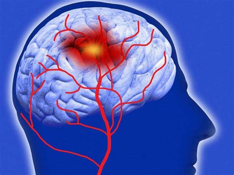 Accidentul Vascular Cerebral Cauze Simptome Tratament Yve Ro The Best