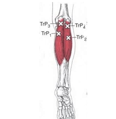 Illustration Of Four Myofascial Trigger Points Mtps Of Gastrocnemius