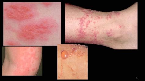 Dermatite Che Cosè Sintomi Tipologie Cause E Come Diagnosticarla