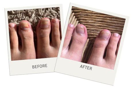 Acrylic nails and fungus nail ideas nail photo gallery. Fingernail Fungus, Nail Health, Treatment & Symptoms