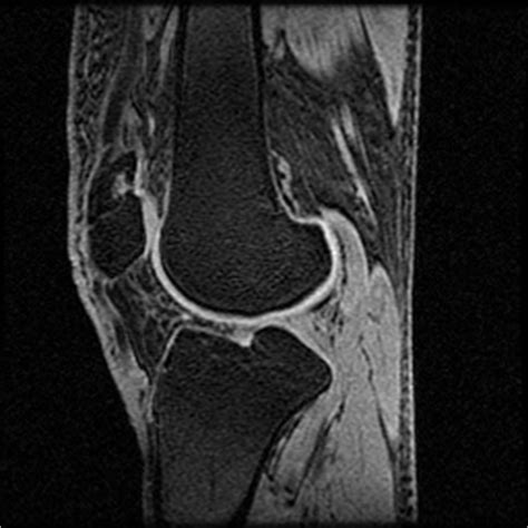 Femoral trochlear dysplasia with tibial eminence fracture ...