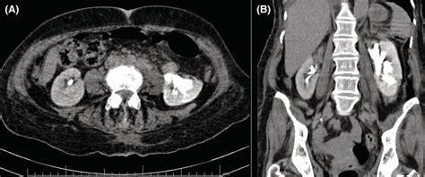 The Abdominopelvic Ct Scan A Few Hours After Venoplasty Shows A