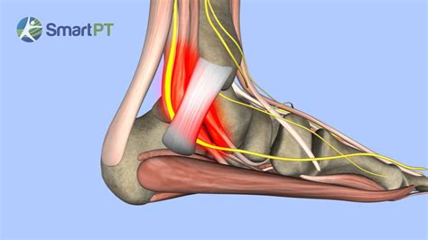 Tarsal Tunnel Syndrome Youtube