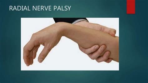 Radial Nerve Palsy And Tendon Transfer
