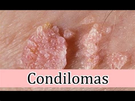 Condilomas Tratamiento Para Verrugas Genitales Como Eliminar