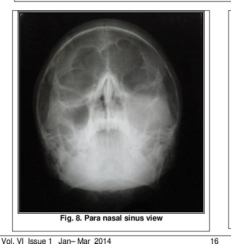 figure 13 from large radicular cyst of the posterior maxilla a case report semantic scholar