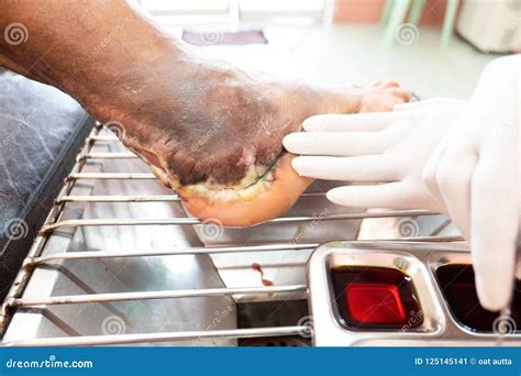 Closeup Infection Wound In The Foot Of Patients Stock Image Image Of
