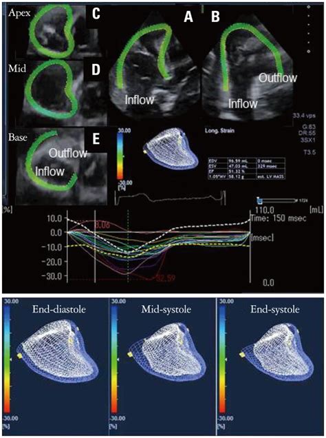 Right Ventricular 3 Dimensional Speckle Tracking Echocardi Ography