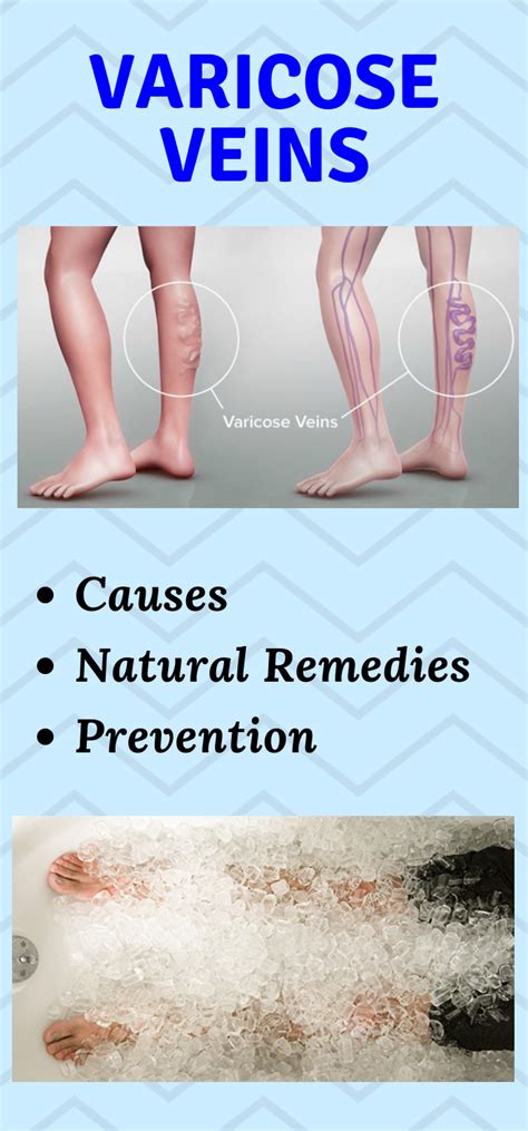 Natural Health Advice Varicose Veins Causes Natural Remedies And