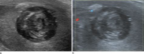 Testicular Epidermoid Cyst Ultrasound