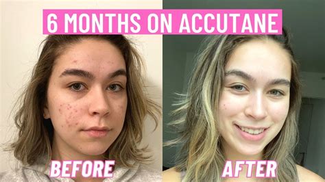 Accutane Before And After Face Acne Six Month Drugs Channel