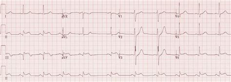 Inferior Stemi Litfl Ecg Library Diagnosis