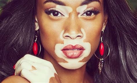 Model With Rare Skin Disease Is Changing The Face Of Fashion Model