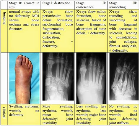 Heidimates Medicine Diabetic Charcot Neuroarthropathy Classification