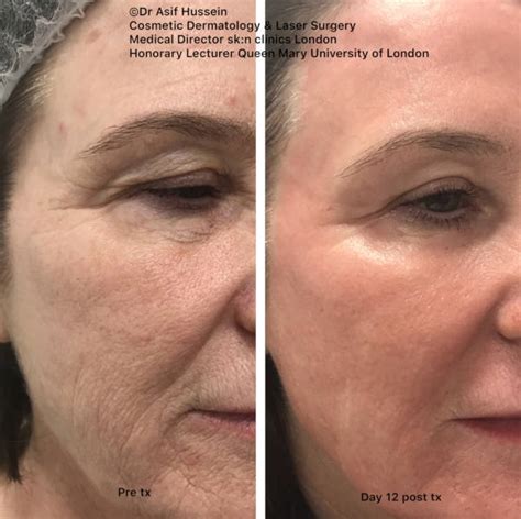 Fully Ablative CO Laser Resurfacing Treatment Dr H Consult
