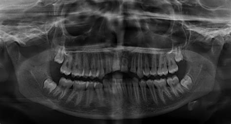 Diagnostic Perplexity Of Panoramic Radiograph Bmj Case Reports