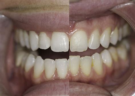 Hat ein schonendes verfahren für die professionelle zahnaufhellung bei ihrem zahnarzt entwickelt: Bleaching Zahnaufhellung - Dres. Klein Zahnarzt Knittelfeld