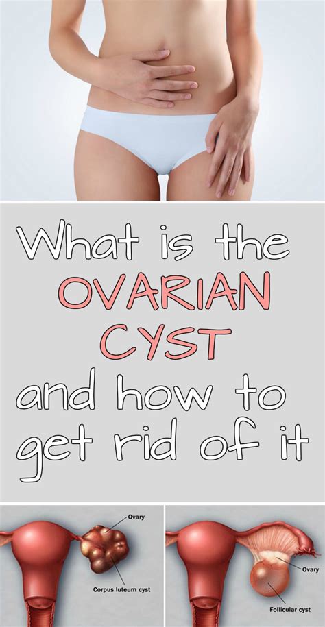 What Is The Ovarian Cyst And How To Get Rid Of It