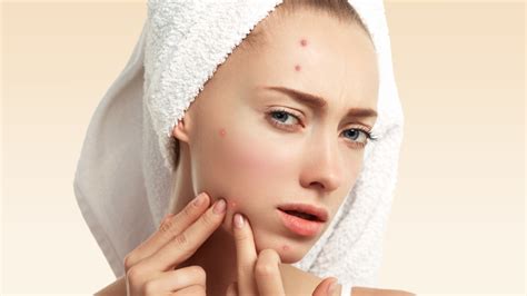 How To Remove Pimples 5 Ways To Get Rid Of Pimples Fast Lifestyle