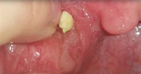 What Causes Tonsil Stones If You Still Have Tonsils You Basically Can
