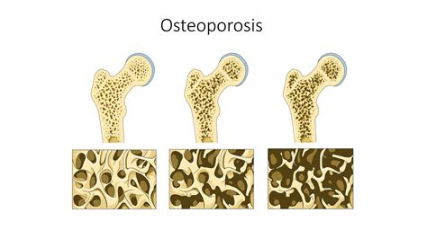 What Is Degenerative Bone Disease General Center