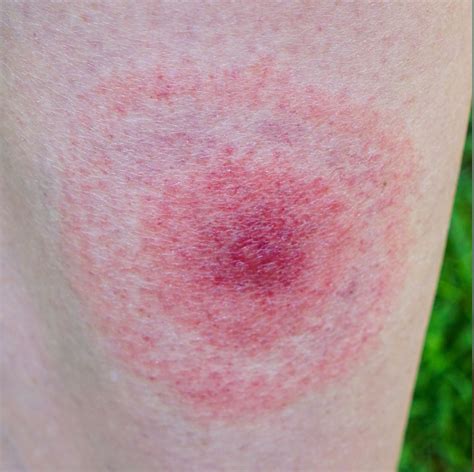 From Ticks To Spiders To Bed Bugs Theyre All Pretty Gnarly Tick Bites Pictures Bed Bug Bites
