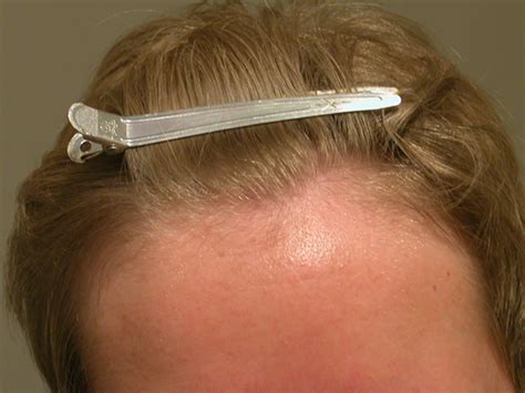 Female Suffering From Male Pattern Baldness In The Hairline Hair Loss