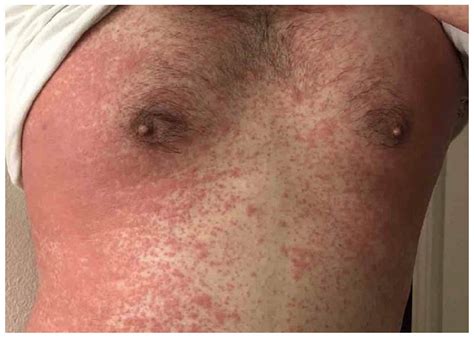 A Case Of Delayed Maculopapular Eruption To Ibuprofen And Acute