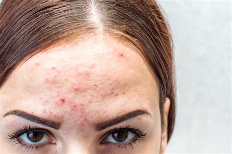 Pimples On Forehead What Are The Causes And Treatments