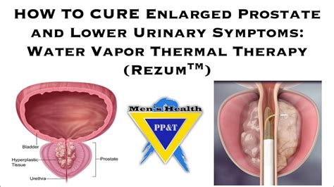 How To Cure Enlarged Prostate Lower Urinary Symptoms Water Vapor Thermal Therapy Rezum