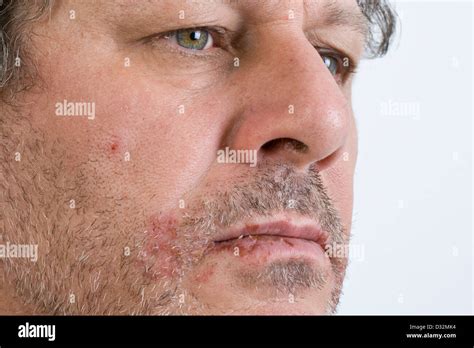 Cold Sores On Lips Stock Photo Alamy