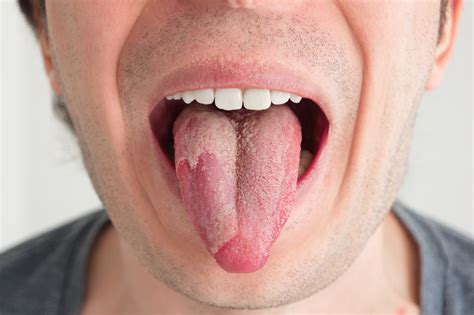 Grzybica języka przyczyny objawy leczenie Zdrowie w INTERIA PL