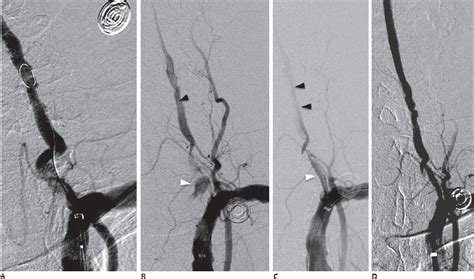 Management Of Vertebral Artery Origin Stenosis Neupsy Key