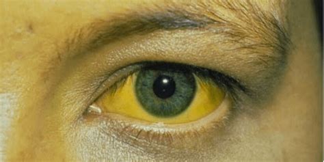 Yellow eyes are generally a symptom of jaundice, which is a discoloration of the skin and eyes caused by elevated levels of a pigment called bilirubin. Choose Treatment for Irritating Yellow Eyes