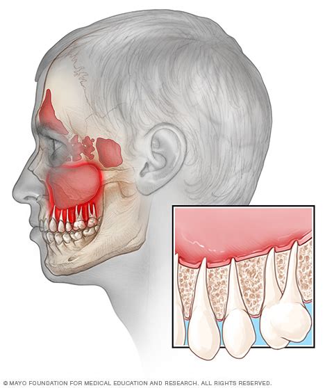 They can be caused by bacteria, viruses, allergies, smoking, and other less frequently, bacterial growth causes sinus infection and fungal sinus infection is very infrequent. Can a sinus infection be caused by a tooth? - Dr Chauvin