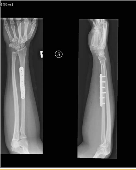 Forearm Single Bone Fracture The Orthopedics Malaysia Blog