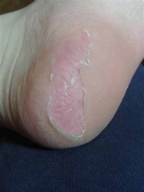 Peeling Skin On Feet Peeling Dead Skin Off Feet Mishkanetcom