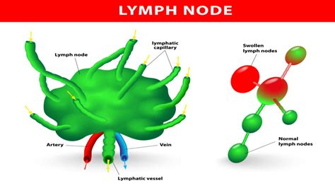 Swollen Lymph Nodes Doctall Living