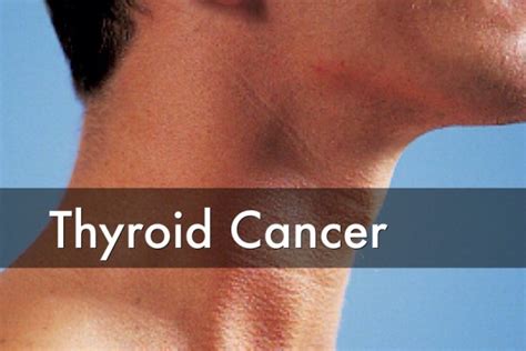 26 Thyroid Cancer Pictures