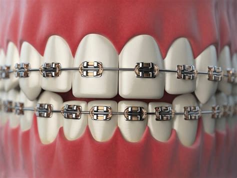 Straight Talk About Braces For Adults Melton Dental House
