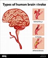 Types of human brain stroke illustration Stock Vector Image & Art - Alamy