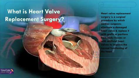 Ppt Heart Valve Replacement Surgery Procedure Powerpoint Presentation